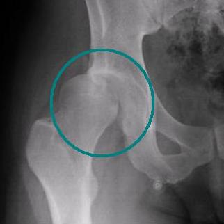 Dislocated hip X-ray 